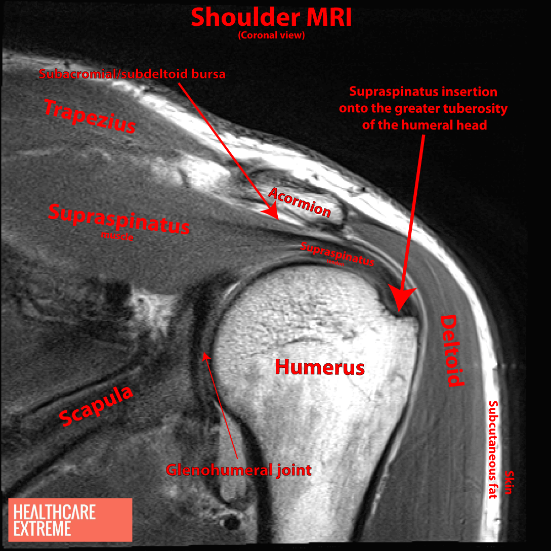 Shock And Suspense With Shoulder Subacromial Impingement Syndrome