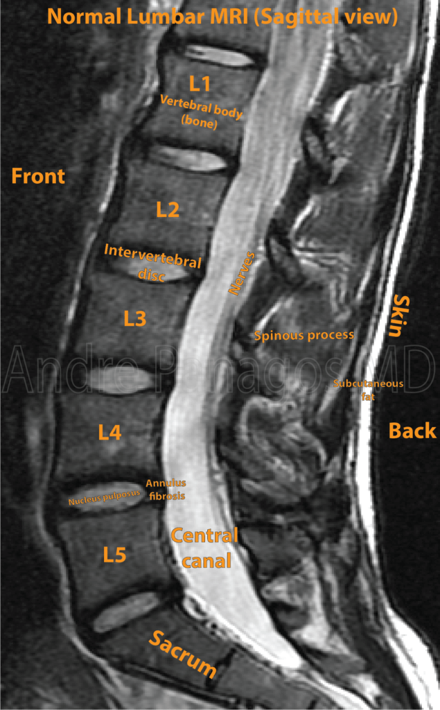 Normal Sagittal Lumbar MRI