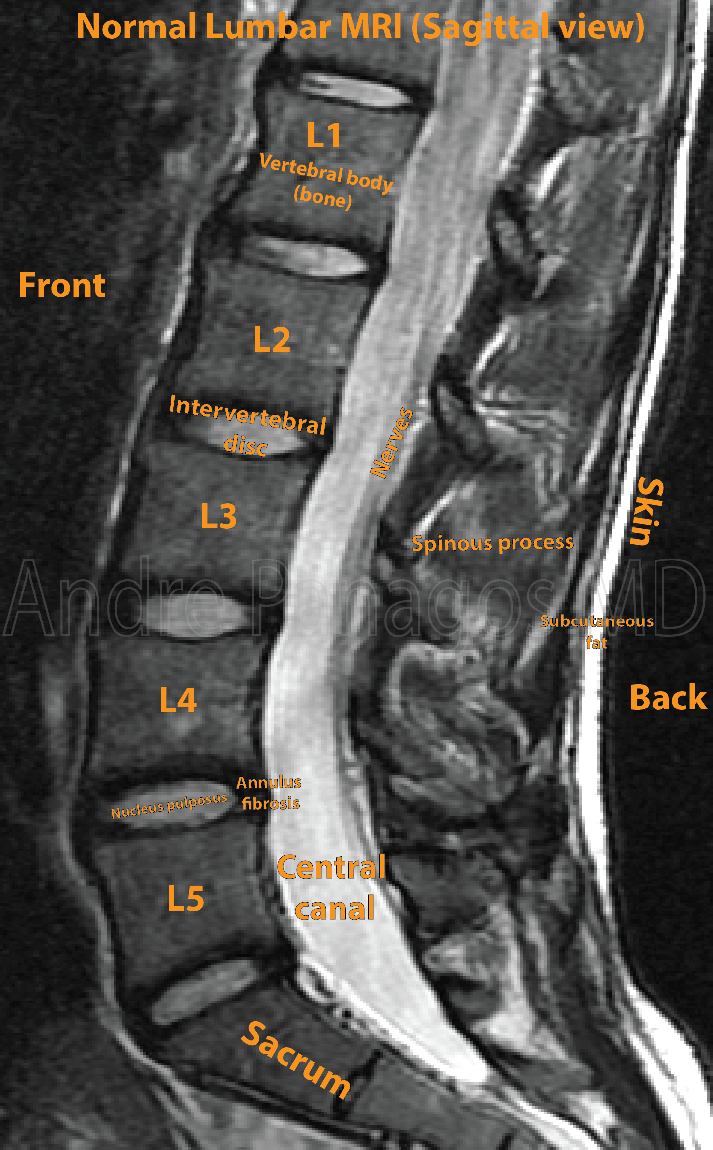 lumbar spine mri labeled