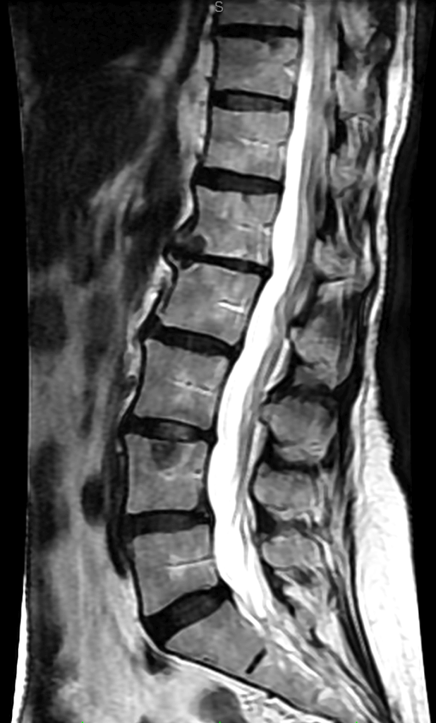 Lateral view of lumbar spine T2 image