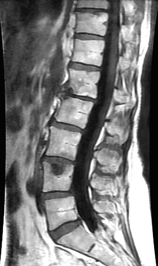 Lateral view of lumbar spine T1 image